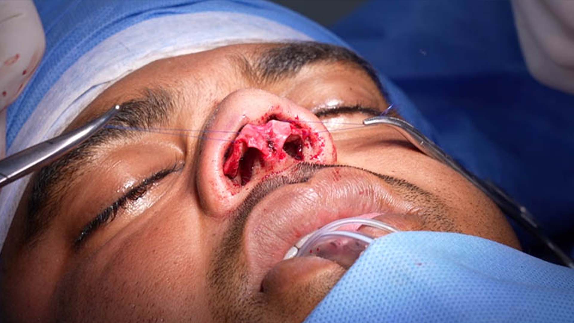 Rhinoplasty for a Broad Nose Man
