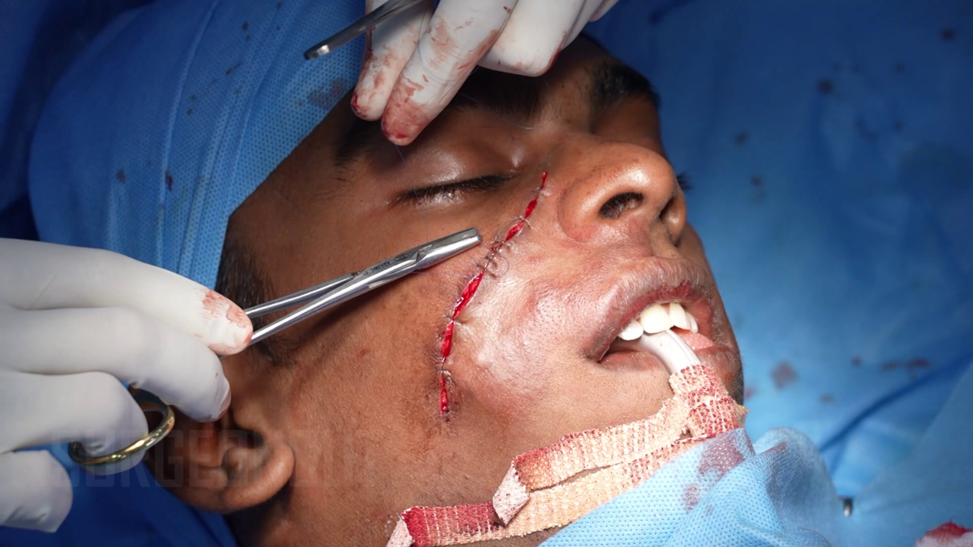 Large Hemangioma Removal Face and Chin